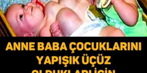 Çocuklarını Yapışık Üçüz Olduğu İçin Terketmişti